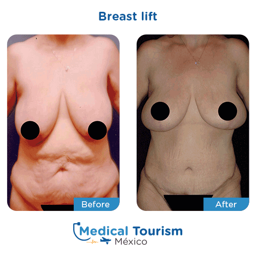 Best Surgeons For Breast Lift | Medical Mexico
