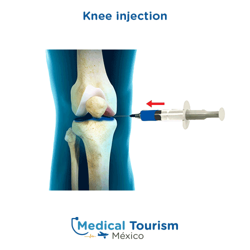 Best Orthopedists For Knee Injection | Medical Tourism Mexico