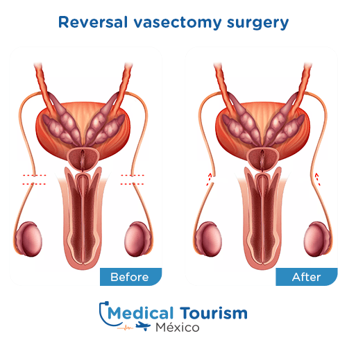 Vasectomy & Vasectomy Reversal