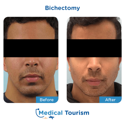img plastic surgery bichectomy before after 3 medical tourism international