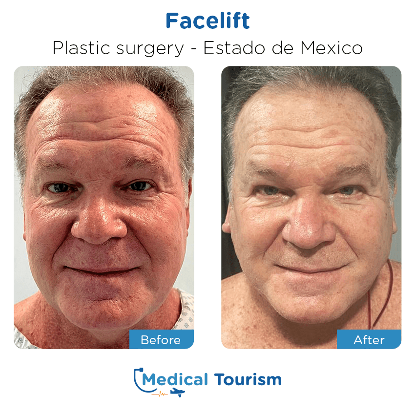 plastic surgery before and after of patients in Estado de México