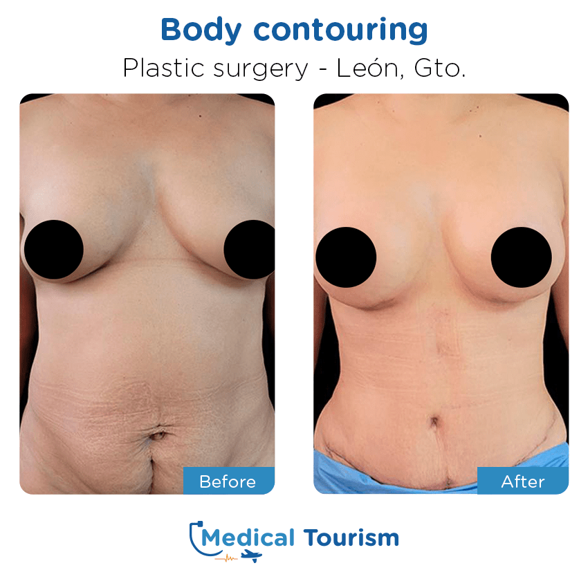 plastic surgery before and after of patients in León